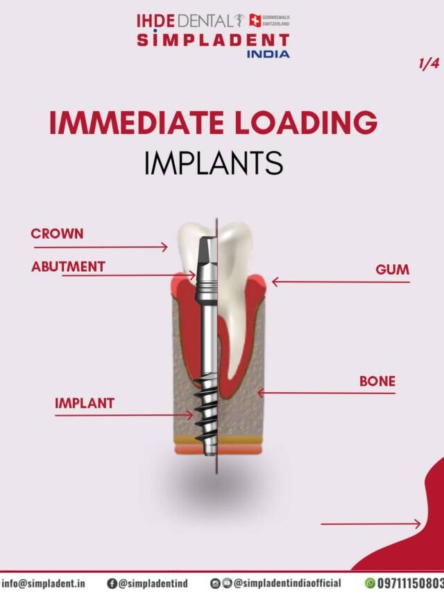 Unlock Your Perfect Smile: The Power of Immediate Loading Implants